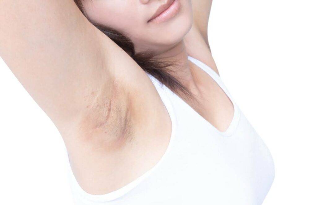 Woman stretching her arms up revealing Axillary Web Syndrome, also known as Cording, in her armpit area after Breast Cancer Surgery.