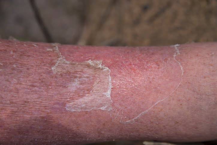 Close up of a leg that has developed Cellulitis.